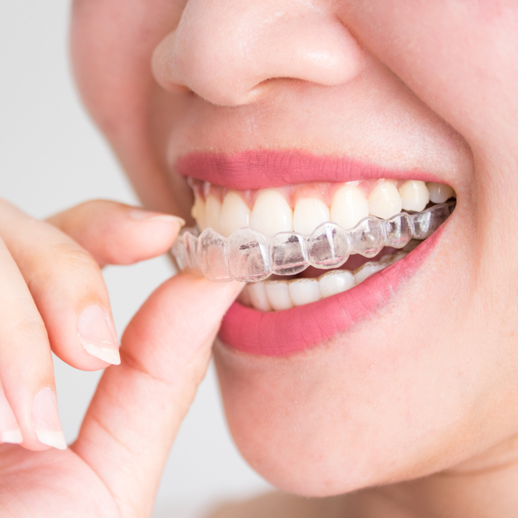 Invisalign Oralprev Vila Leopoldina